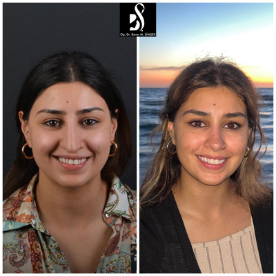 25-34 year old woman treated with Rhinoplasty, Chin Filler, Botox, Cheek Fillers, Chin Implant, Ear Surgery, Lip Fillers, Septop - Natural and subtle change