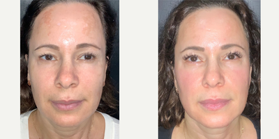 35-44 year old woman treated with NeoGen Plasma - 8 weeks following a single Neogen Plasma session! Results will continue to enhance up to 12-24 months.