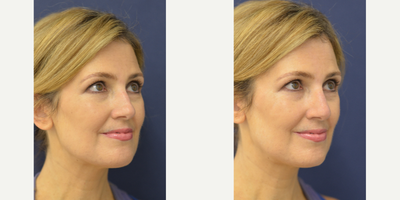 Female Non Surgical Nose Job - Non Surgical nose job using Juevederm