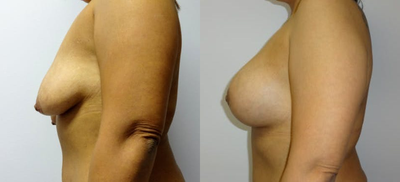 35-44 year old woman treated with Breast Lift with Implants - This is a massive weight loss patient who had severe drooping and deflated appearing breasts. She desired a fuller and liftedlook. Her breasts were augmented with425 cc round smooth high profilesilicone implants with along with a Circum-Vertical Mastopexy
