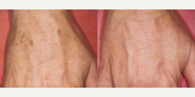 Woman treated with PicoWay - Woman treated with PicoWay