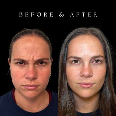 25-34 year old woman treated with Botox, Dysport, Micro Botox - Check out this incredible transformation by Laura Stelk, DNP, APRN at the office of Dr. John Burns! This patient received customized neuromodulator treatment (Botox, Dysport) to achieve these natural, beautiful results.Laura is passionate about providing exceptional aesthetic care, combining advanced expertise with a personalized approach to help every patient achieve their most confident, natural-looking results.