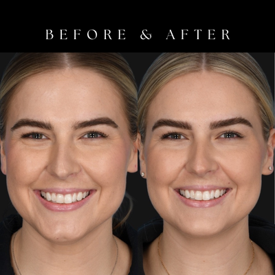 25-34 year old woman treated with Botox, Micro Botox, Dysport - Check out this incredible transformation by Laura Stelk, DNP, APRN at the office of Dr. John Burns! This patient received customized neuromodulator treatment (Botox, Dysport) to achieve these natural, beautiful results.Laura is passionate about providing exceptional aesthetic care, combining advanced expertise with a personalized approach to help every patient achieve their most confident, natural-looking results.