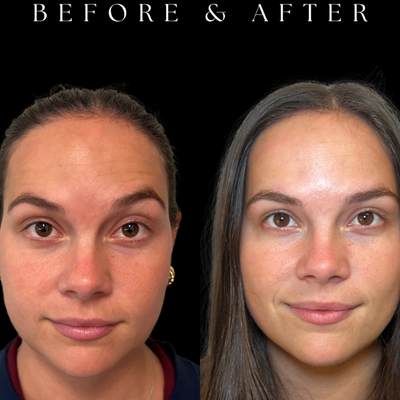 25-34 year old woman treated with Botox, Dysport, Micro Botox - Check out this incredible transformation by Laura Stelk, DNP, APRN at the office of Dr. John Burns! This patient received customized neuromodulator treatment (Botox, Dysport) to achieve these natural, beautiful results.Laura is passionate about providing exceptional aesthetic care, combining advanced expertise with a personalized approach to help every patient achieve their most confident, natural-looking results.