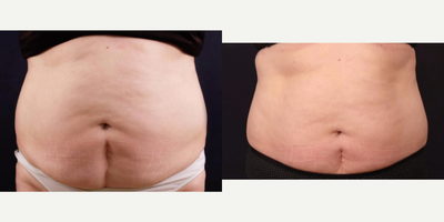 Before and After of Vanquish - This patient did 6 treatments of Vanquish and had great results. Her satisfaction was so high, she is coming back monthly to get a Vanquish which we highly recommend if someone wants their results to last.