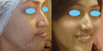 18-24 year old woman treated with Rhinoplasty, Cleft Lip And Palate Repair - 19 year old who underwent a rhinoplasty and and a cleft lip and palate repair (revision)