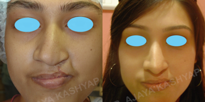 18-24 year old woman treated with Rhinoplasty, Cleft Lip And Palate Repair - 19 year old who underwent a rhinoplasty and and a cleft lip and palate repair (revision)