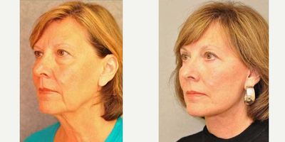 NaturalLift - Woman treated with NaturalLift
