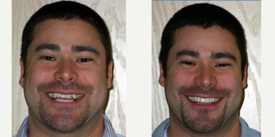 18-24 year old man treated with Six Month Smiles - Patient wanted his teeth straighten quickly and effectively due to severe crowding. In only 5 months, we were able to straighten his teeth and enhance his smile.