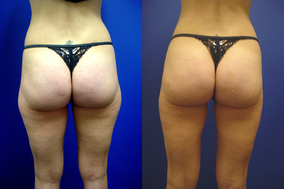 Cellulaze - 32 year old female who underwent Cellulaze and laser assisted liposuction of the flanks, inner, and outer thighs.