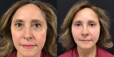 55-64 year old woman treated with Eyelid Surgery, Facial Fat Transfer, Chemical Peel - AUTOLOGOUS FAT GRAFT TO FACE FROM THE PERIUMBILICAL AREA WITH REMOVAL OF A TOTAL OF 215 GRAMS FROM THE UMBILICUS AND PLACEMENT OF 30 GRAMS TO THE LOWER LIDS, MIDFACE, NASOLABIAL AND COMMISSURE WITH A LOWER LID PHENOL-CROTON PEEL, BILATERAL UPPER LID BLEPHAROPLASTY.