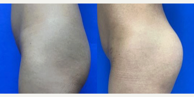 35-44 year old woman treated with Butt Augmentation - 25-34 year old woman treated with Butt Augmentation