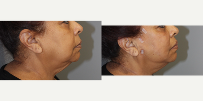 65-74 year old woman treated with NovaThreads - PDO Thread Lift of midface, lower face, and jawline 68 y/o F, G1P1, 52,140 lbs