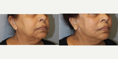 65-74 year old woman treated with NovaThreads - PDO Thread Lift of midface, lower face, and jawline 68 y/o F, G1P1, 52,140 lbs