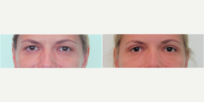35-44 year old woman treated with Upper Eyelid Surgery/Blepharoplasty under local anesthesia - This young active woman presented with the concern of excessive heavy skin over both eyelids.  She had attempted botox and xeomin a number of times without sufficient correction of her concerns.  She presented to our office requesting a more definitive and long-lasting solution.Pre-procedure exam demonstrated significant excess loose upper eyelid skin with reasonably elevated eyebrows.  Thus we agreed that an upper blepharoplasty would be a good option for her rejuvenation.Only under local anesthesia and mild oral sedation with xanax, we performed an upper blepharoplasty in our office.  Procedure time was 45 minutes and she was able to drive herself to the office the next day for her 24-hour follow up appointment.  Sutures were removed 5 full days after procedure.Her results demonstrate a natural opening of both eyes so that both of her lids were now prominently visible.  She stated that she looked and felt more awake since she did not have as much skin sitting over her eyes.  She also noted that makeup application was much easier with less skin to navigate.