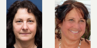 Woman treated with Eyelid Surgery - Featured is an upper and lower blepharoplasty performed on my wonderful patient. This procedure is designed to restore contour and elevate sagging muscle without making the eyes look rounded or smaller. For many patients, drooping and/or excess skin around the eyes can be an inherited trait.