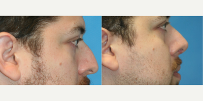 25-34 year old man treated with Rhinoplasty - This gentle man had a drooping nasal tip with a dorsal hump. We took care of both issues.&nbsp;