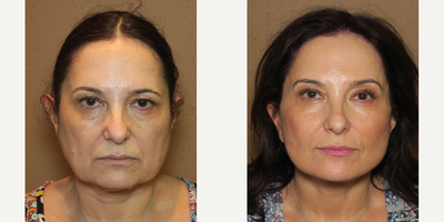Woman treated with Facelift - Woman treated with mid facelift, endoscopic brow lift, buccal fat pad removal and necklift.