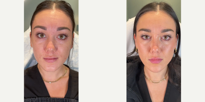 Woman treated with Facial - Woman treated with Facial