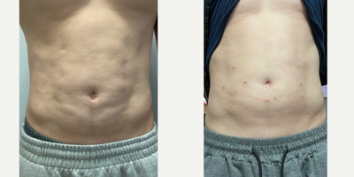 25-34 year old man treated with Fibrosis from Vaser Liposuction - Patient had Liposuction done VASER, about 5 yrs ago that left him with significant scarring, fibrosis and irregularities. pt had 1 Revision done in the past that didn't help at all. this is his 2nd revision and 1st Revision with me.
