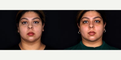 23 year old woman treated with Liposuction, PrecisionTx, Facial Fat Transfer to chin - 23 year old female treated with liposuction to face and submental neck (Precision tx) and fat transfer to the chin. Photos depict before and 3 months after surgery