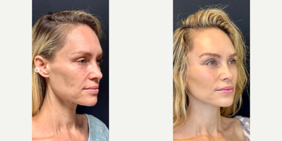 Woman treated with Deep Plane Facelift, Facelift, Neck Lift - She was gorgeous before and all we did was my DEFINE LIFT. A Deeplane Extended Facelift Including Necklift and the Elevation of the brows, as well as a touch of fat transfer. You can see she looks like herself just rejuvenated. My goal with facelift rejuvenation is always to try to make the patient a little more prettier or handsome. It's never meant to change the way they look.