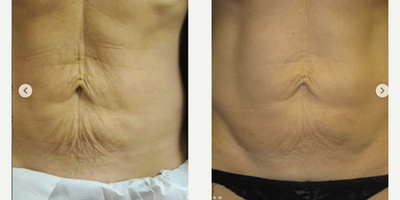 Woman treated with Skintyte - Woman treated with Skintyte