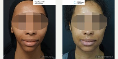 25-34 year old woman treated with Chin Implant, Jaw Implants - Chin & Jaw Implant