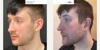 25-34 year old man treated with Chin Implant, Jaw Implants - Chin & Jaw Implant Surgery