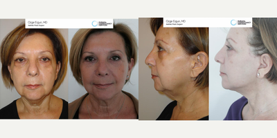 45-54 year old woman treated with Facelift - Facelift surgery performed by Ozge Ergun