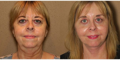 Woman treated with Facelift - Woman treated with Facelift
