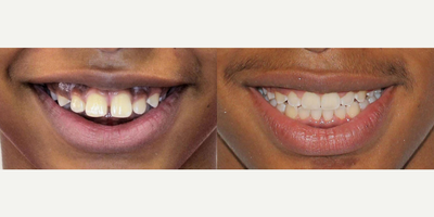 Patient treated with Braces - Patient treated with Braces