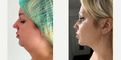 25-34 year old woman treated with Chin Liposuction - 28 years old female, underwent double chin liposuction and facetite to get better contouring.