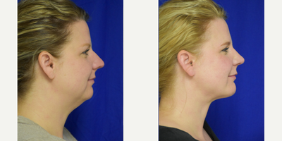 45-54 year old woman treated with Rhinoplasty - Primary Rhinoplasty with chin implant and liposuction in New Orleans woman by Facial Plastic Surgery Specialist, Dr. Sean Weiss in Metairie, Louisiana
