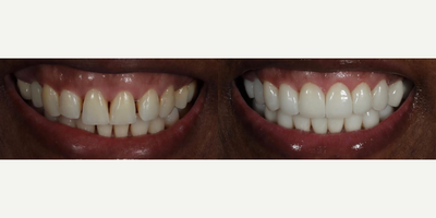 Woman treated with Smile Makeover, Porcelain Veneers, Dental Crown - Smile makeover with 20 porcelain restorations (veneers and crowns) for a more vibrant youthful smile. We enhanced shapes, color, and reduced signs of aging. 