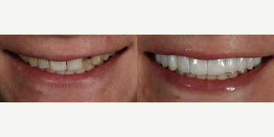 25-34 year old woman treated with Smile Makeover, Porcelain Veneers - Smile Makeover.This patient presented with a missing lateral tooth from a previous trauma, cavities, and old restorations. She was in her 20s and felt that her smile had aged her. She was looking for a healthier and brighter smile that she would feel much more confident with. We did a full smile redesign with 1 implant and 9 handcrafted Feldspathic porcelain veneers. We would consider this an anti-aging case which shows that we need to treat patients based on their symptoms and not their age. Age is truly just a number.