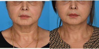 55-64 year old woman treated with Facelift, Mini Facelift, SMAS Facelift, Lower Facelift, Neck Lift, Deep Plane Facelift - Face and neck lift. Deep Plane