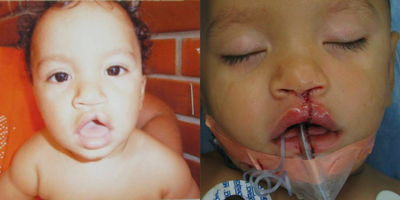 Cleft Lip And Palate Repair - This happy six month old boy had an incomplete cleft lip (left), which was repaired by Dr. Ransom (right).