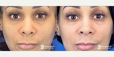 35-44 year old woman treated with Hyaluronidase - The patient is a 43-year-old female who had concerns with her previous lip and under-eyefiller received with another provider. Dr. Chiang treated the lips and under eyes withhylenex.The after results are 6 months post-treatment.