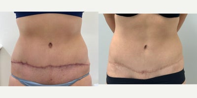 18-24 year old woman treated with Tummy Tuck Revision - This patient in her early 20s had a tummy tuck elsewhere, but was unhappy with the result. The scar was high and irregular on the lower abdomen, with standing cones of tissue (dog ears) at each end. She also felt that the pubic mound was pulled abnormally high and tight. The plan was to perform a revision mini tummy tuck with abdominal liposuction, which would help mobilize any remaining skin and facilitate a lower to final scar position. In addition, during wound closure the elevated tissue on the abdomen was anchored to the muscles on the lower abdomen with sequential tension sutures, thereby reducing tension on the pubic area. This helped avoid pulling the pubic mound even tighter during the revision. The postoperative photos taken one year after the revision show a much lower, more symmetrical scar.