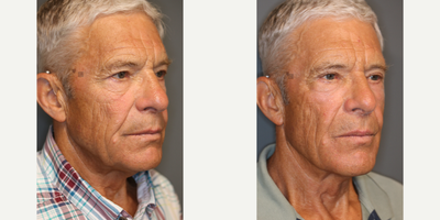 Smoothbeam Laser - Upper lid revision with laser resurfacing.