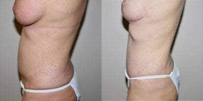 35-44 year old woman treated with Tummy Tuck Revision, Belly Button Surgery, Liposuction, Breast Implant Removal, Breast Lift - 44 yrs, 52, 135 lbs, history of tummy tuck in 2015 with umbilical stenosis, unsatisfactory scar orientation and contour irregularities. Revision includes tummy tuck scar revision with liposuction, umbilicoplasty. She also had her breast implants removed and a breast lift at the same time.