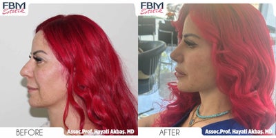 45-54 year old woman treated with Deep Plane Facelift, Double Eyelid Surgery, Mini Neck Lift, Facial Fat Transfer - 45-54 year old woman treated with Deep Plane Facelift, Double Eyelid Surgery, Mini Neck Lift, Facial Fat Transfer