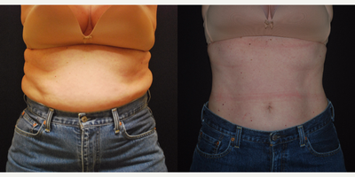 45-54 year old woman treated with Vanquish ME - 5 Vanquish ME Shrinkwrap procedures (Front and back abdomen) with BTL Cellutone after each treatment.
