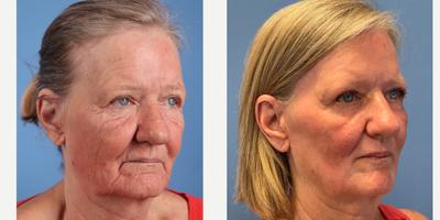 65 year old woman treated with Phenol Peel - Dr.Sukkar performed a Phenol Peel on this 65 year old patient. Post-op photos taken at 3 months post procedure.The Clinic For Plastic Surgery14018 Aesthetic CircleHouston, TX 77062(281)990-8487www.drsukkar.com