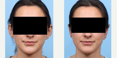 25-34 year old woman treated with Ear Surgery - Dr. Wise performed an otoplasty that successfully corrected this patient's prominent ears, creating a more natural look.