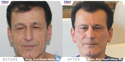 45-54 year old man treated with Deep Plane Facelift, Double Eyelid Surgery - Deep plane face lift was applied to this patient a year ago . at the same time blepharoplasty was applied .Scar was applied on the hair line and almosy invisible.