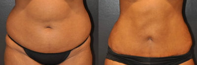 Woman treated with Tummy Tuck - Woman treated with Tummy Tuck