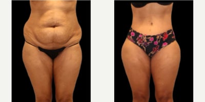 Woman treated with Tummy Tuck - Woman treated with Tummy Tuck