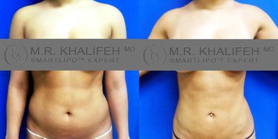 Woman treated with Liposuction - Smartlipo of abdomen. This patient had abdominal lipo in our practice for a leaner more athletic look. The definition of what constitutes an area varies a lot between one center and another, and our area of abdomen covers upper, lower, and anterior sides/flanks.